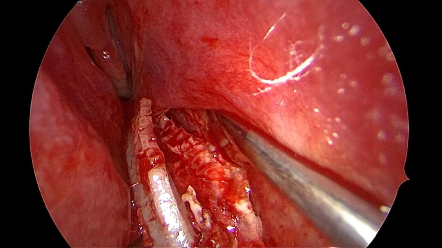 Septoplastia endoscópica