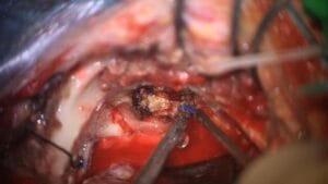 rabdomiosarcoma