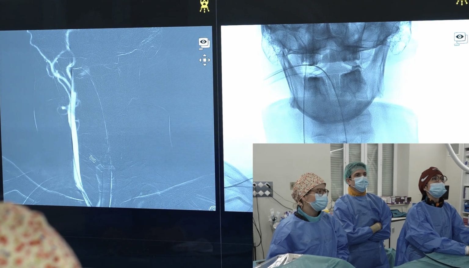 tratamiento endovascular de vasoespasmo