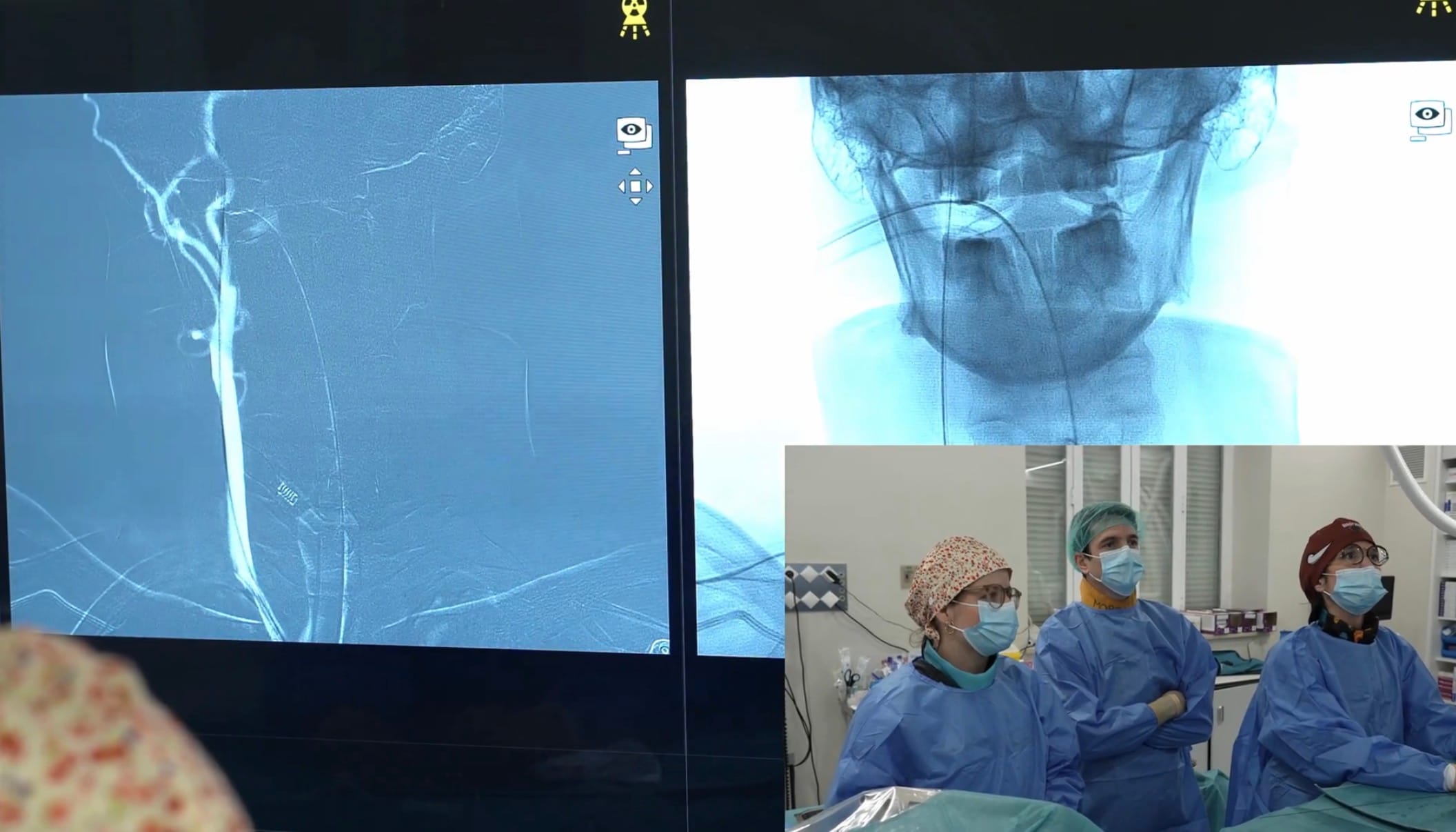tratamiento endovascular de vasoespasmo