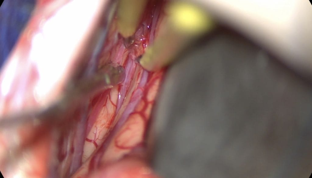craneofaringioma tercer ventriculo