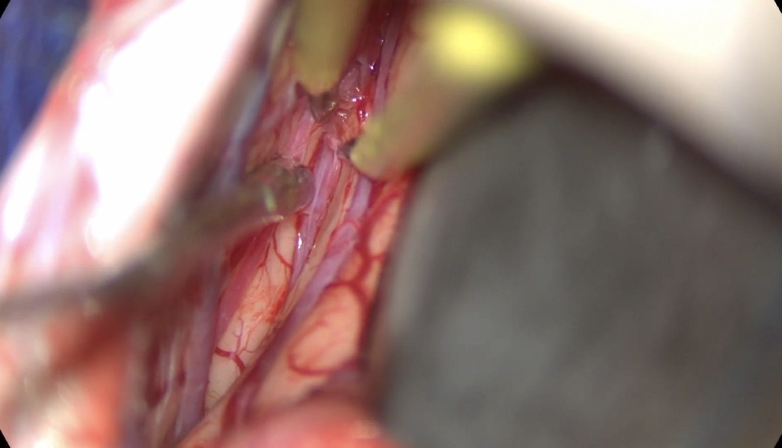 craneofaringioma tercer ventriculo