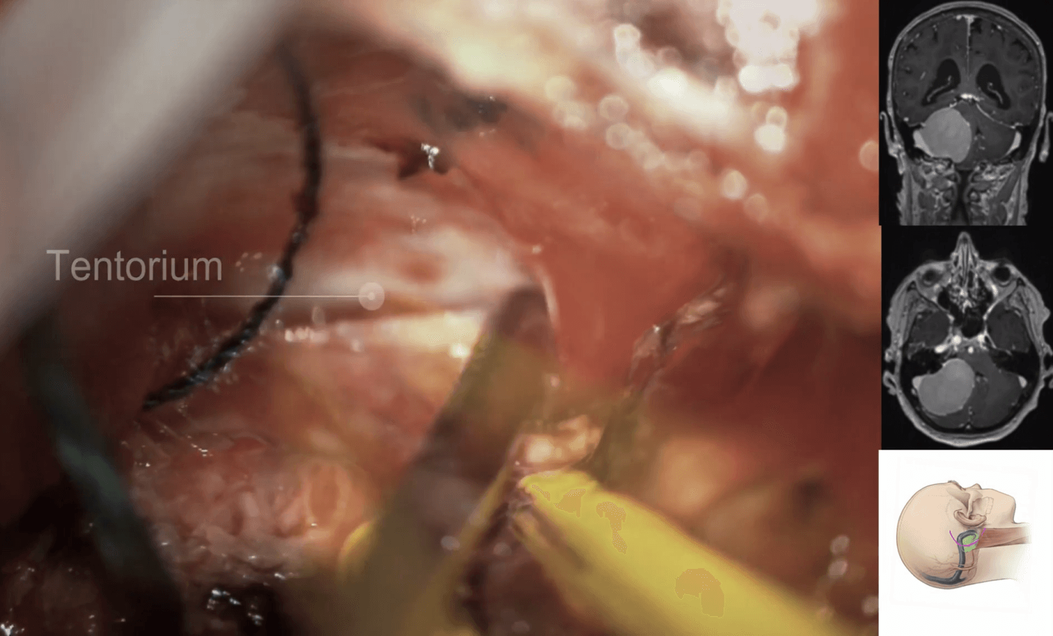 Meningioma