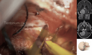 Meningioma