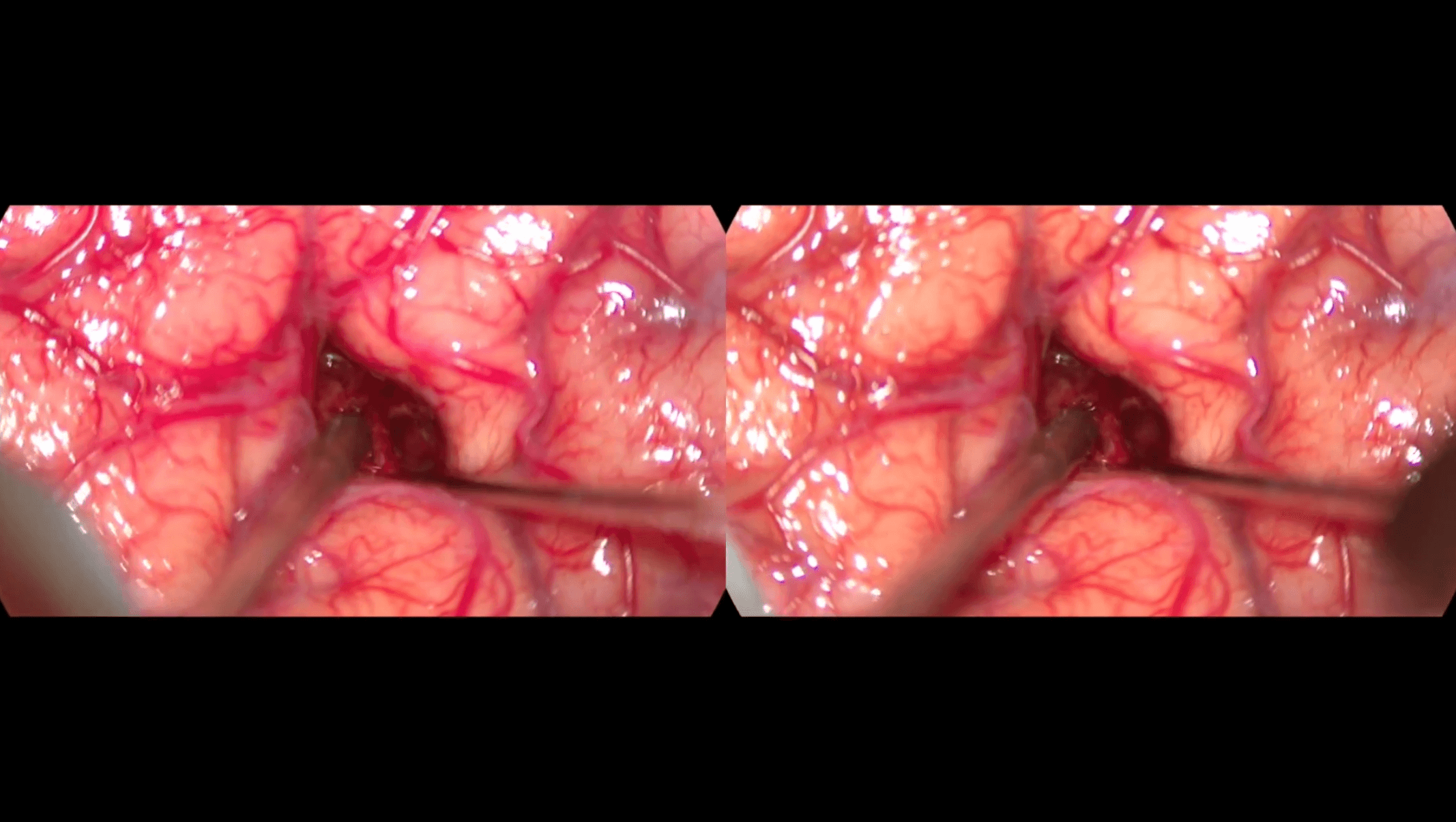 3D VR cavernoma región motora