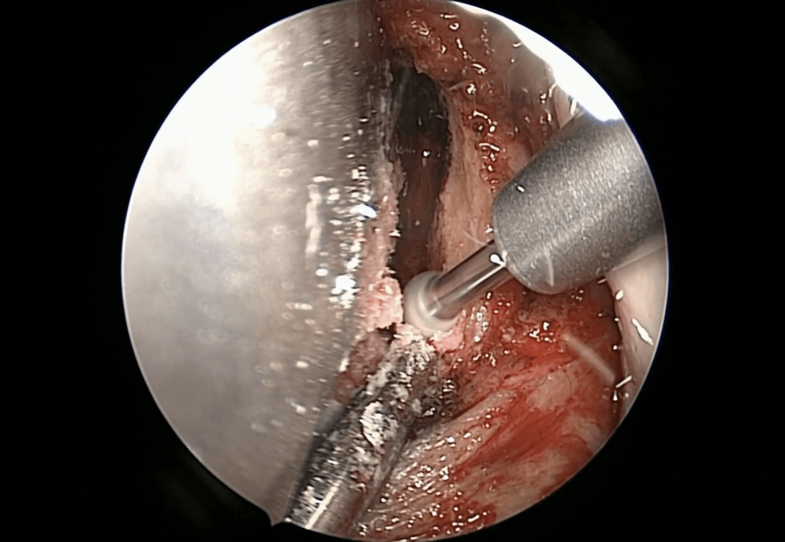 Neoplasia sinonasal