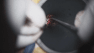 Colesteatoma atical