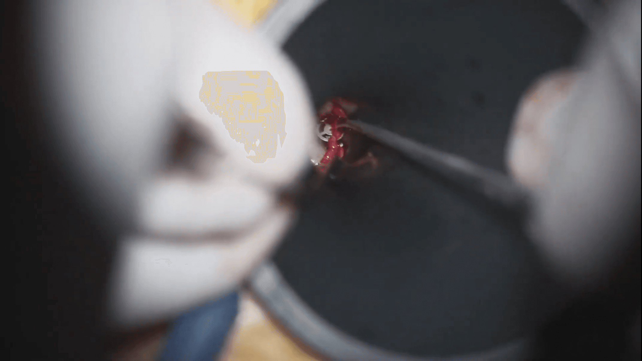 Colesteatoma atical