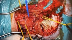 Abordaje infratemporal tipo A de Fisch para paraganglioma yugular C2 - Dr. Miguel Aristegui