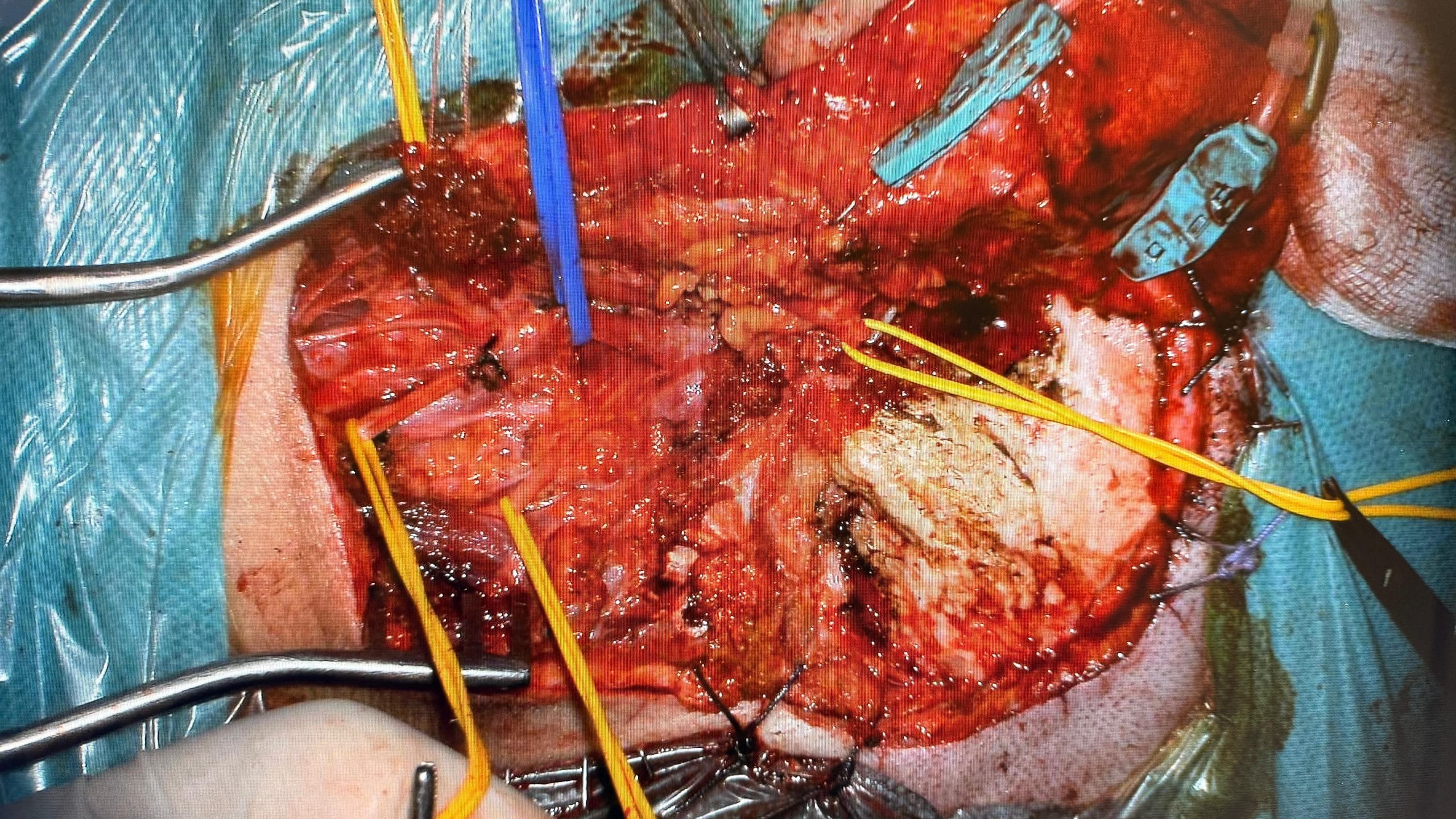 Abordaje infratemporal tipo A de Fisch para paraganglioma yugular C2 - Dr. Miguel Aristegui