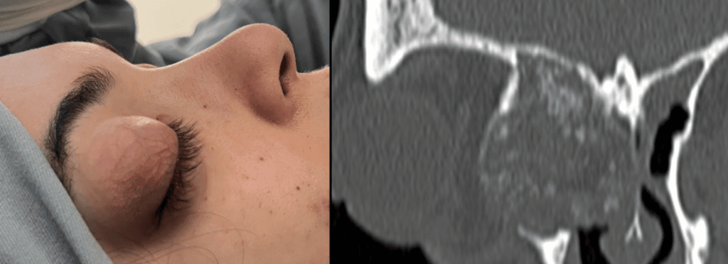 Displasia fibrosa orbitaria: imagen clínica y tomografía computarizada preoperatoria