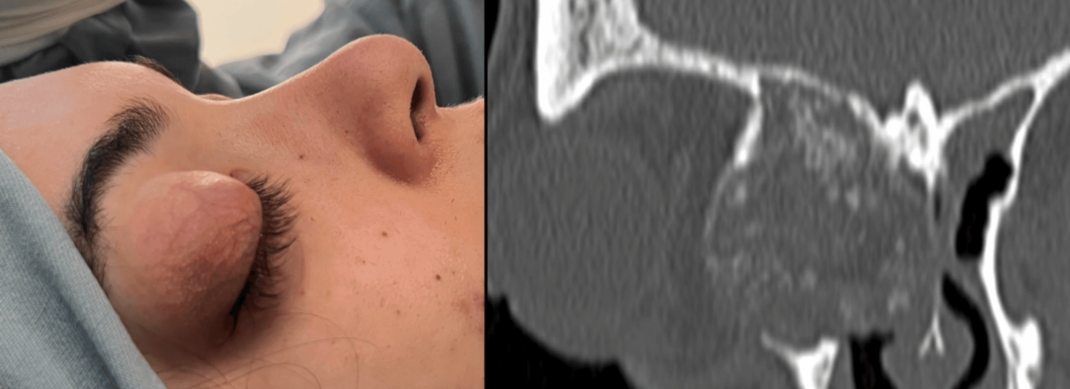Displasia fibrosa orbitaria: imagen clínica y tomografía computarizada preoperatoria
