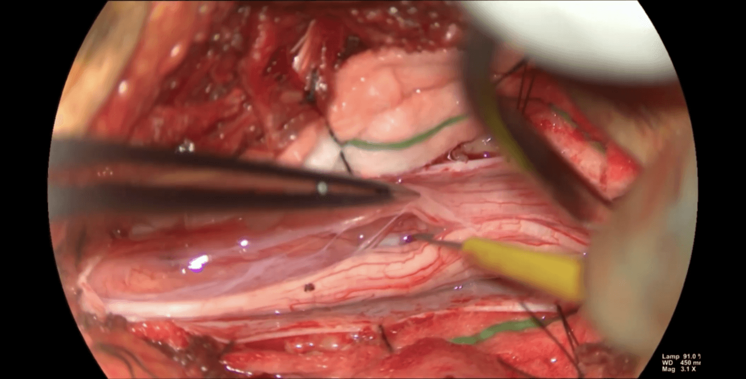 Resección microquirúrgica de ependimoma mixopapilar del filum terminale