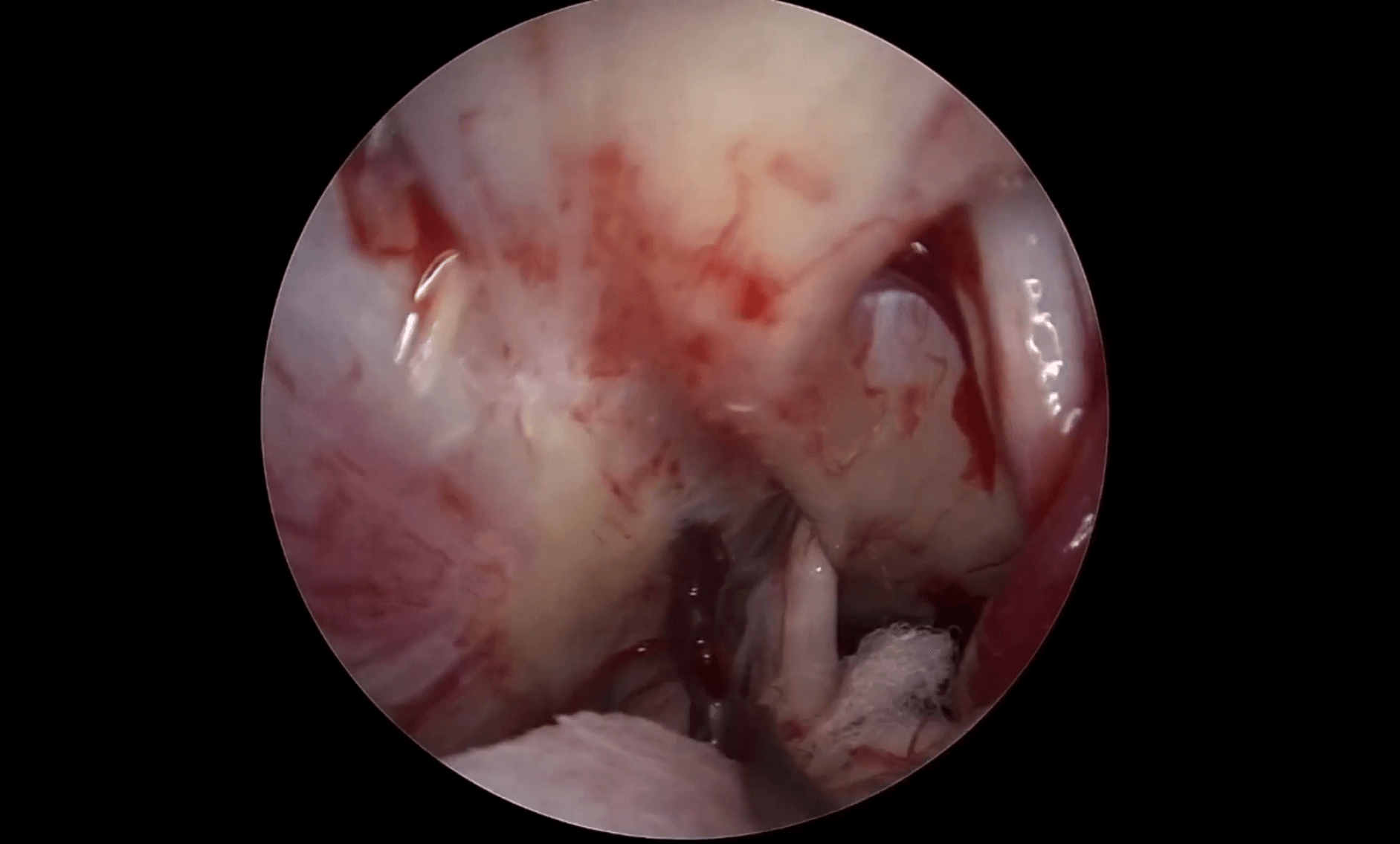 Descompresión microvascular del trigémino mediante craneotomía retrosigmoidea endoscópica