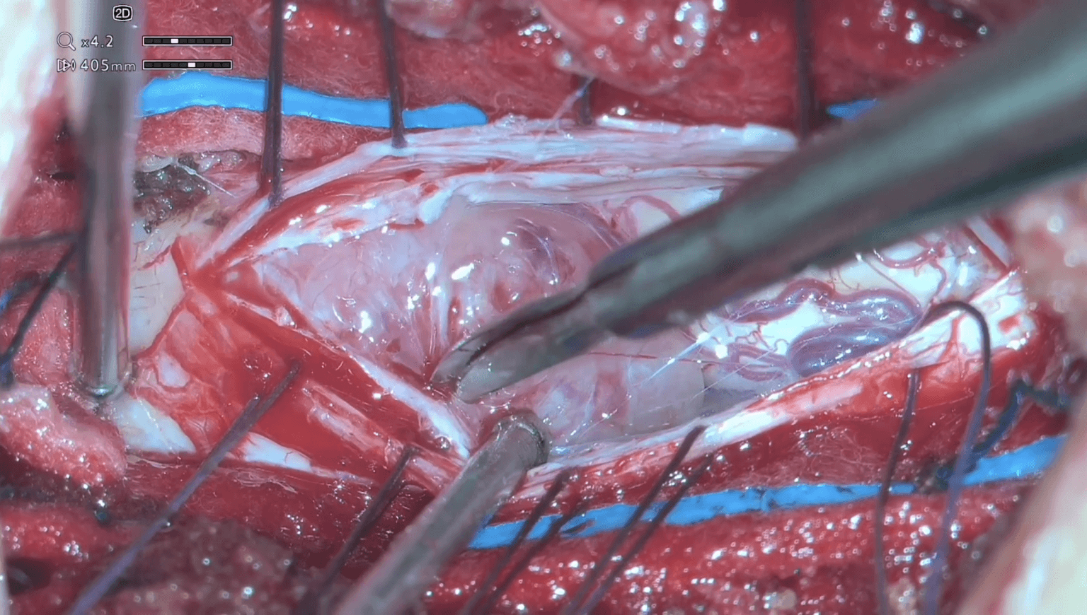 Laminectomía y exéresis de meningioma de cono medular T12