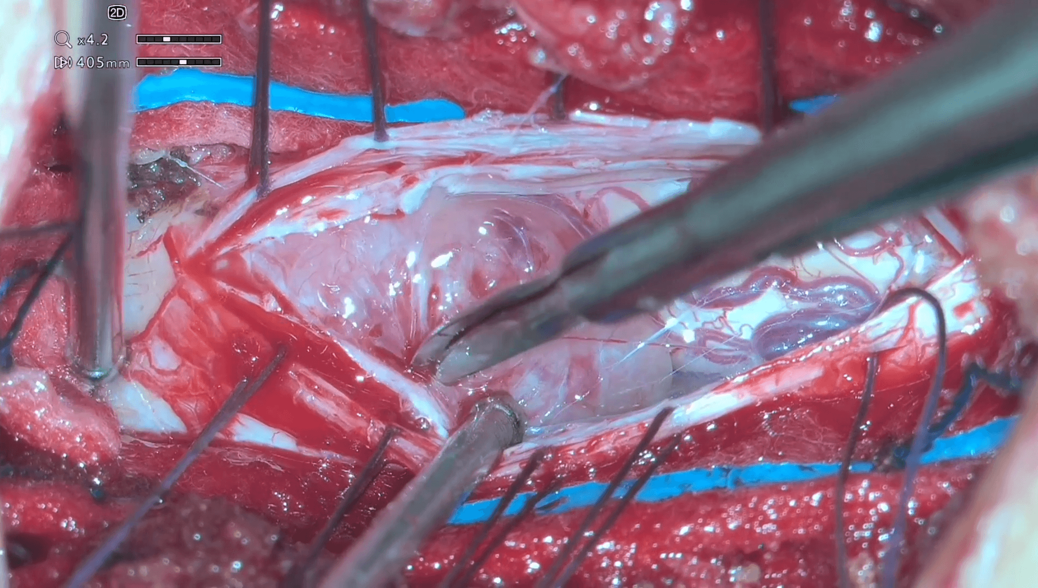 Laminectomía y exéresis de meningioma de cono medular T12