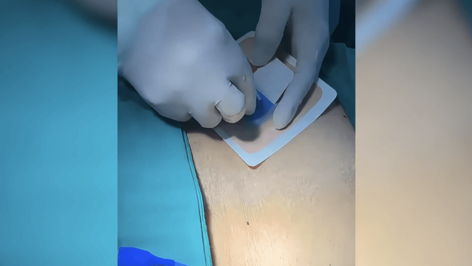 Recambio quirúrgico de catéter de nefrostomía guiado por fluoroscopia