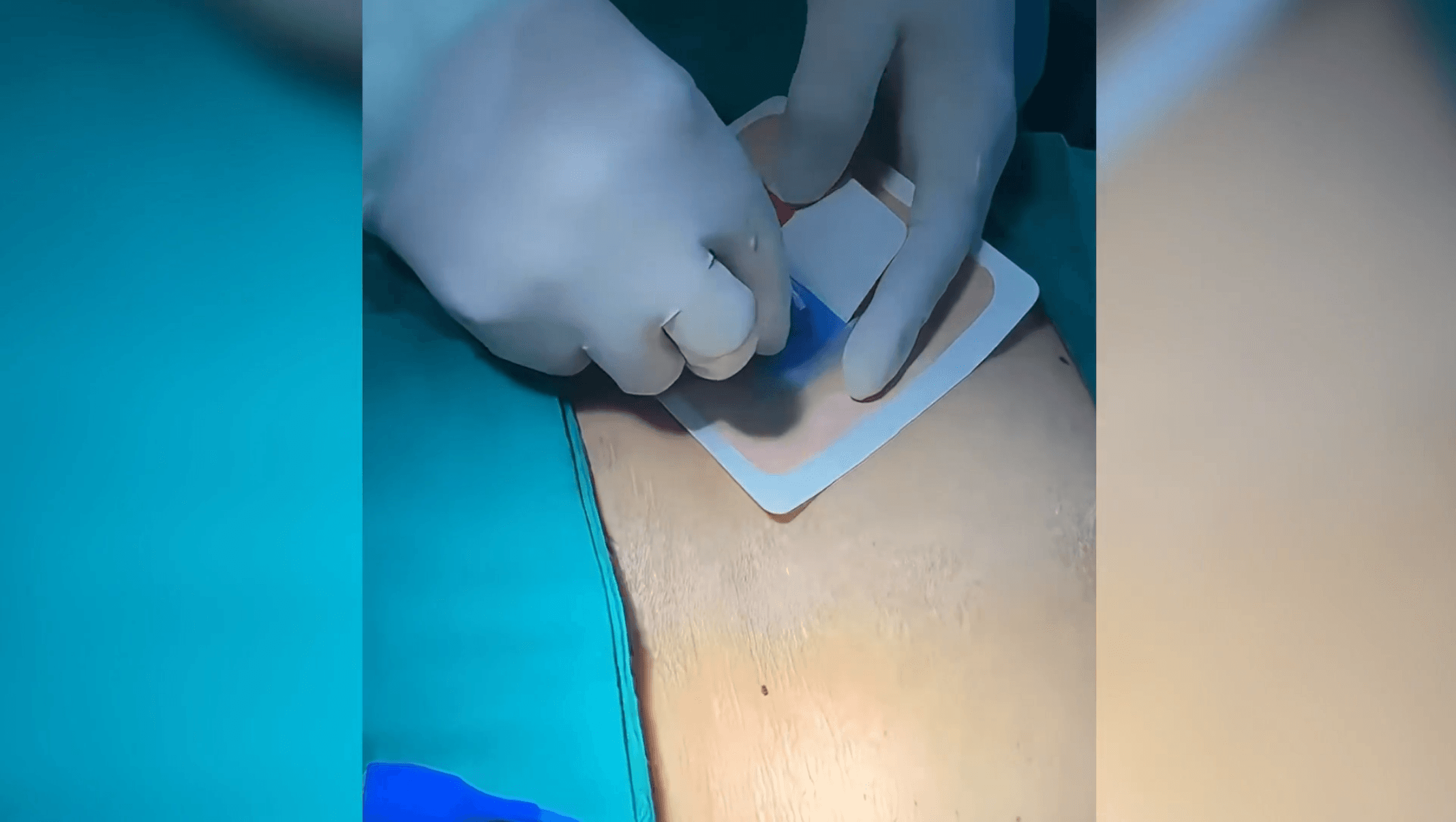 Recambio quirúrgico de catéter de nefrostomía guiado por fluoroscopia