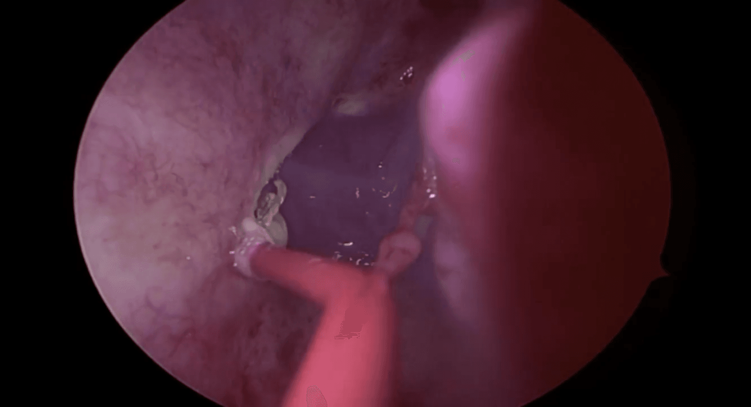 Obtención endoscópica del colgajo nasoseptal paso a paso