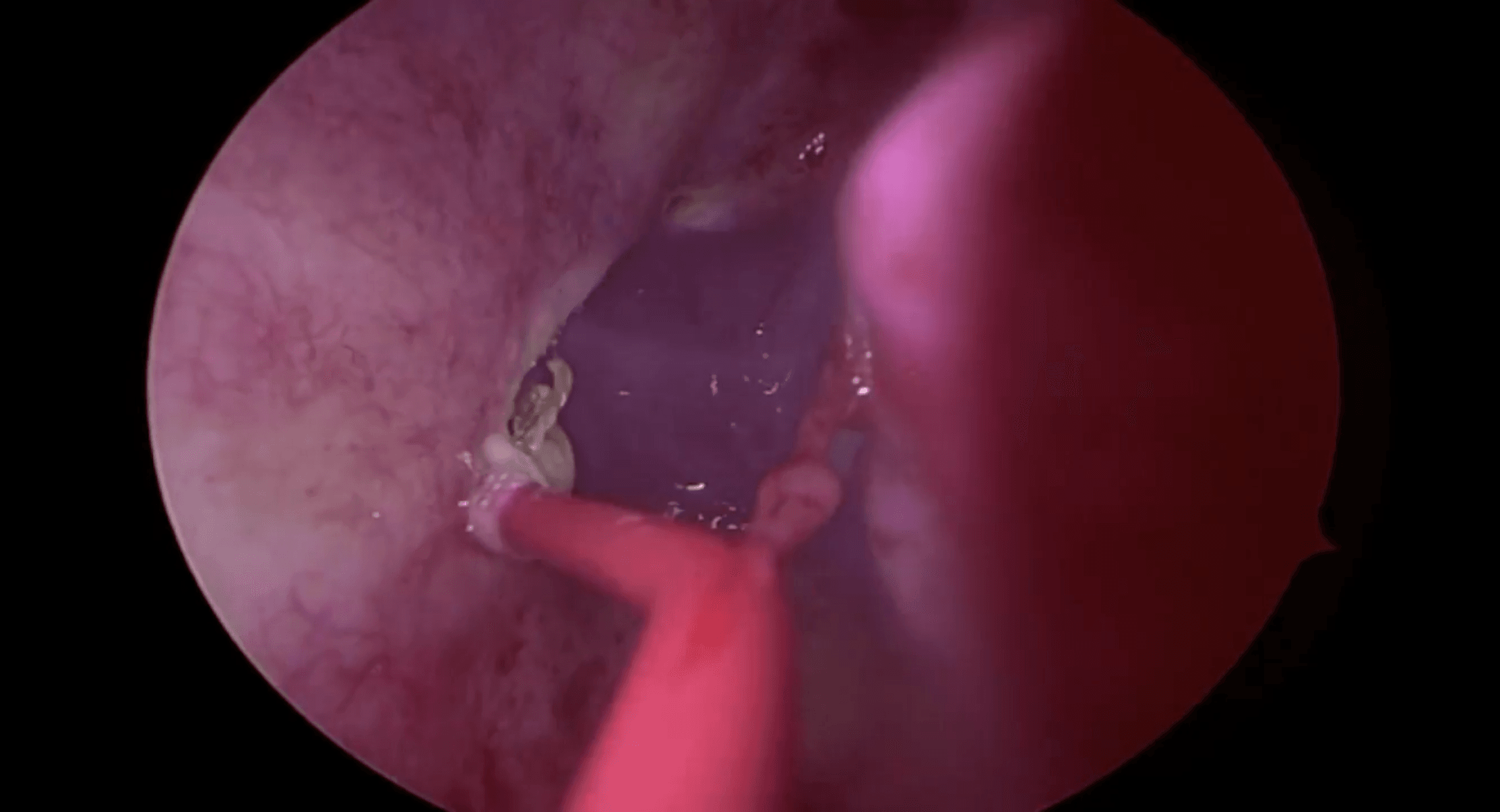 Obtención endoscópica del colgajo nasoseptal paso a paso
