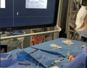 Embolización superselectiva de angiomiolipoma renal izquierdo con microcatéter y pegamento biológico