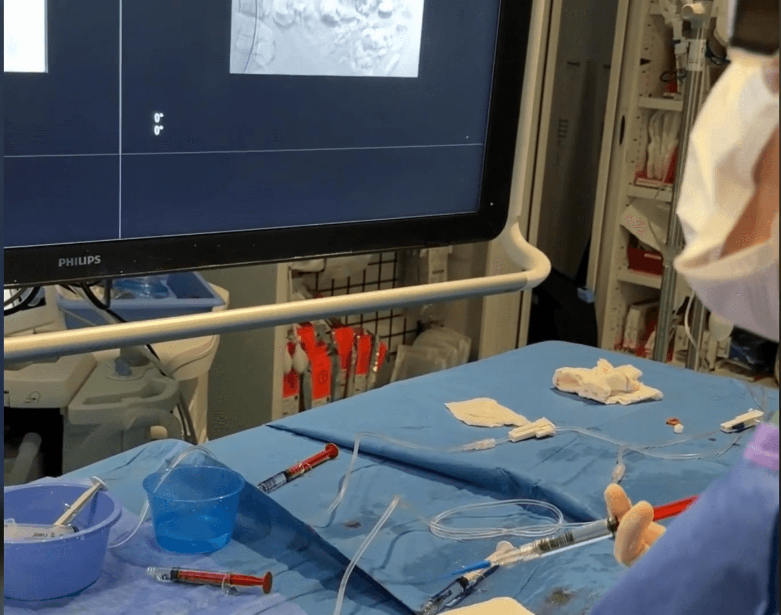 Embolización superselectiva de angiomiolipoma renal izquierdo con microcatéter y pegamento biológico