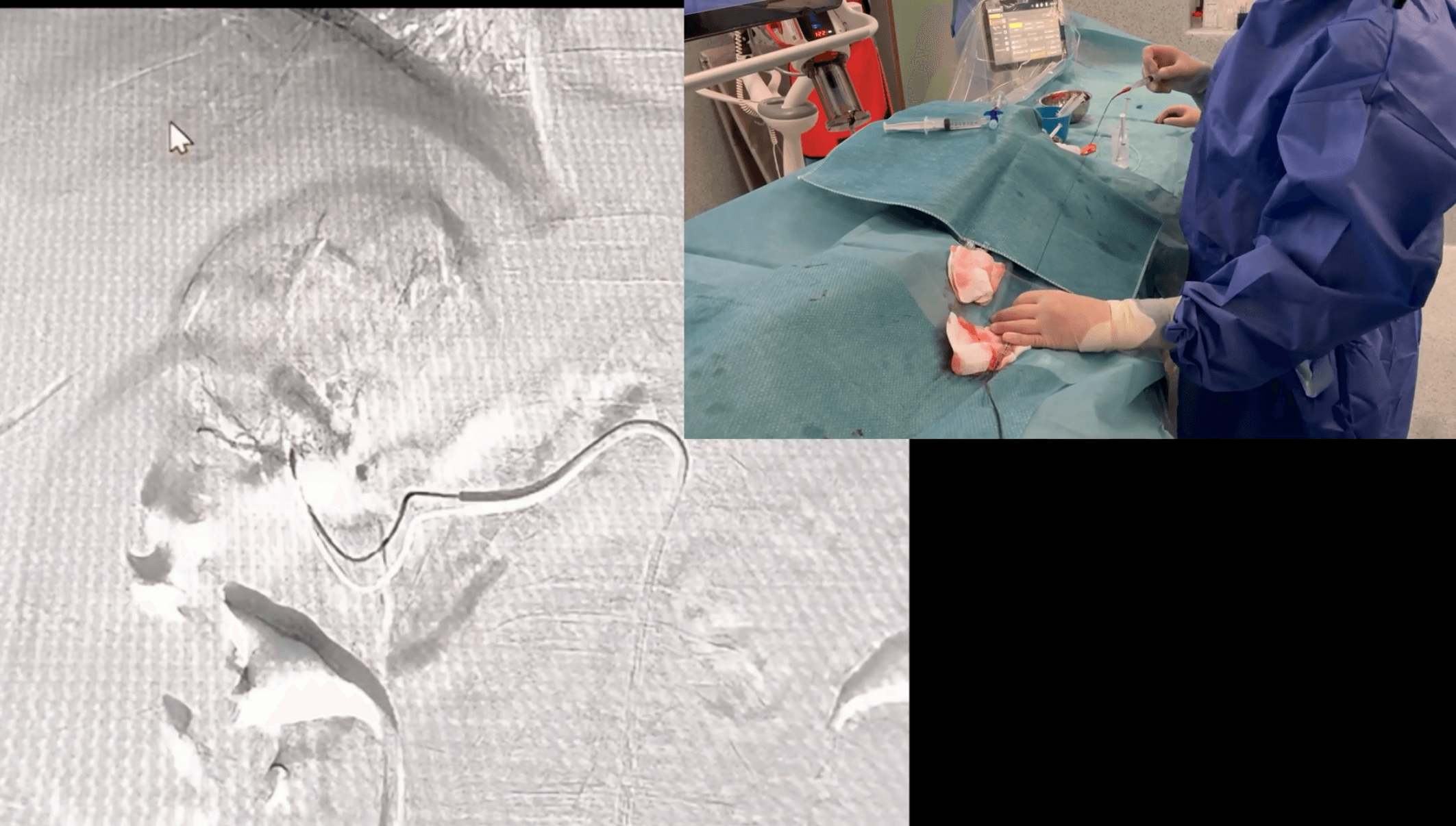 Embolización superselectiva de angiomiolipoma renal en polo superior del riñón derecho