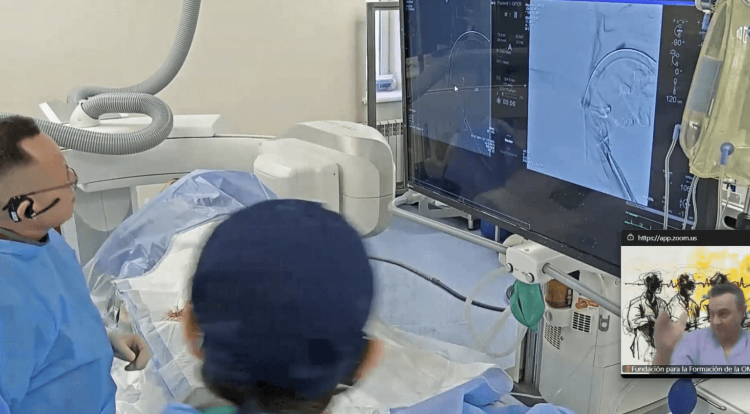 Embolización endovascular de fístula arteriovenosa dural Cognard tipo V
