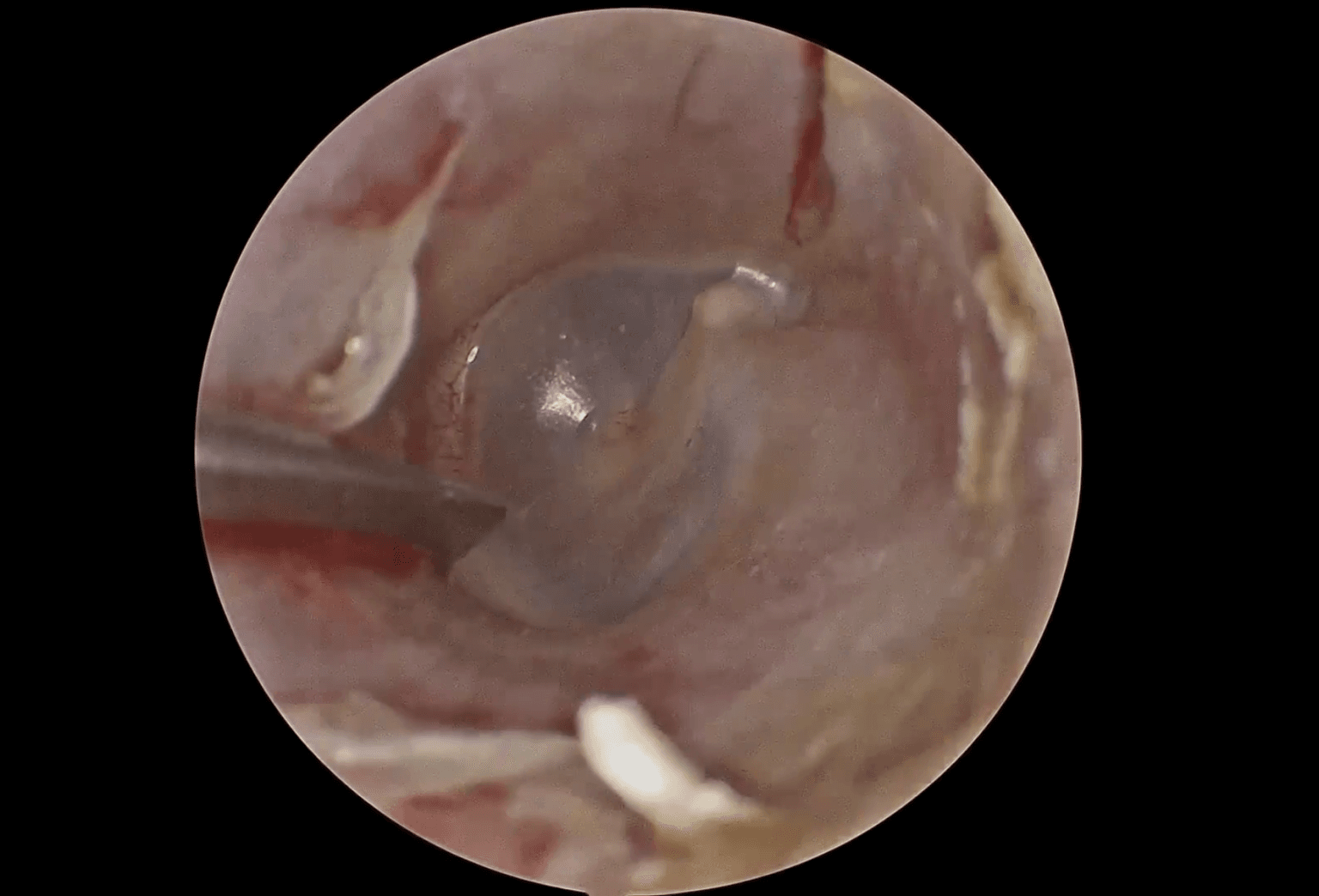 Estapedotomía endoscópica transcanal izquierda por otosclerosis