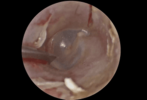 Estapedotomía endoscópica transcanal izquierda por otosclerosis