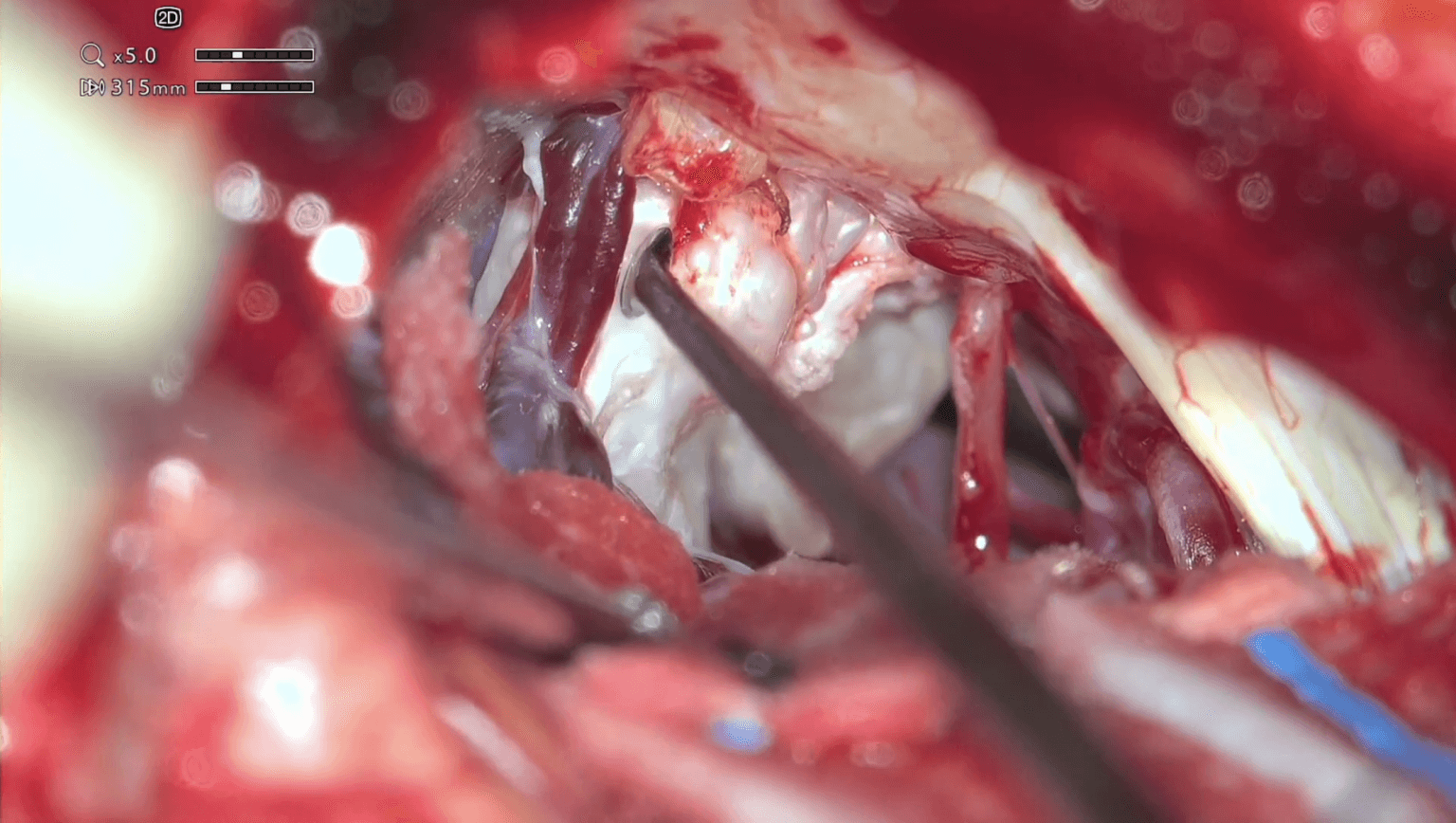 Cirugía de quiste epidermoide recidivado del ángulo pontocerebeloso con neuralgia del trigémino