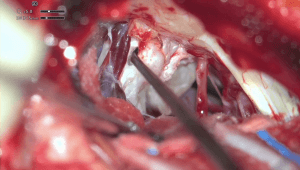 Cirugía de quiste epidermoide recidivado del ángulo pontocerebeloso con neuralgia del trigémino