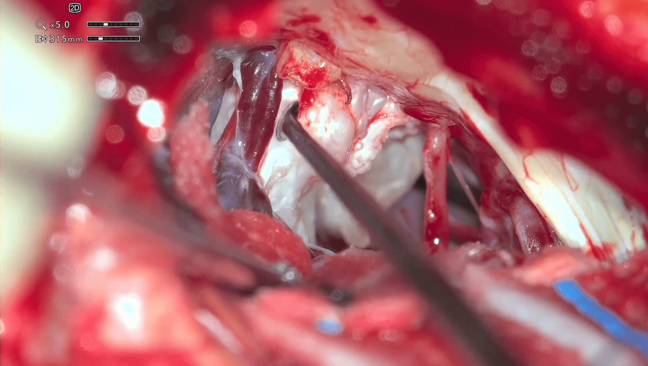 Cirugía de quiste epidermoide recidivado del ángulo pontocerebeloso con neuralgia del trigémino