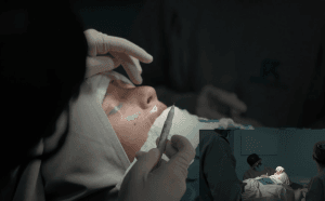 Rinoplastia ultrasónica