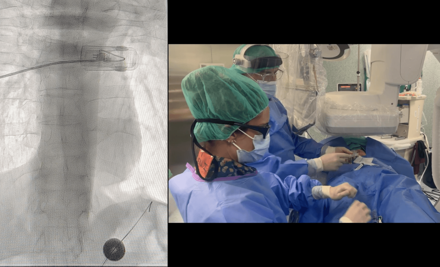 Cambio de gastrostomía a dispositivo de nutrición enteral ENFit bajo escopia