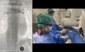 Cambio de gastrostomía a dispositivo de nutrición enteral ENFit bajo escopia