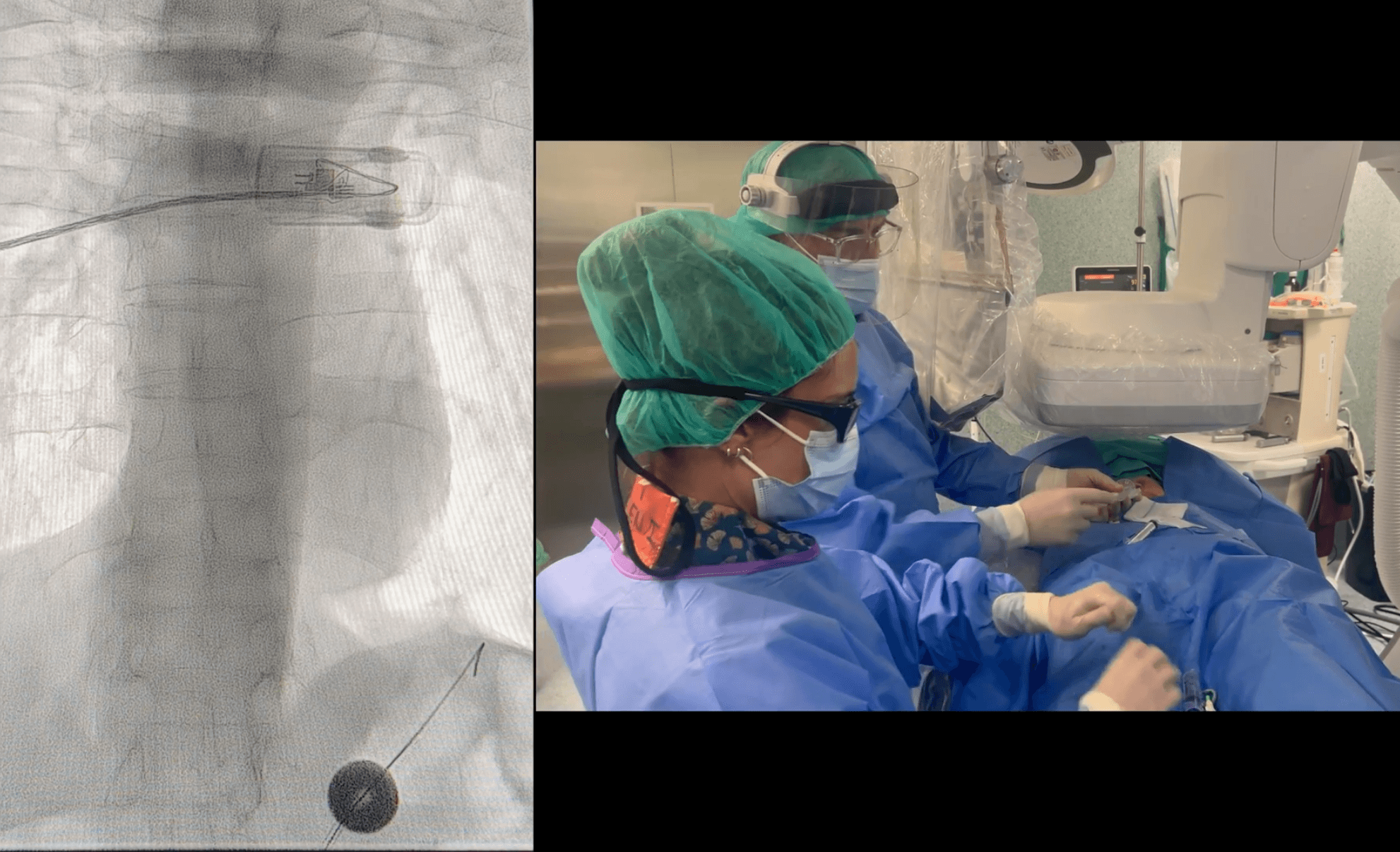 Cambio de gastrostomía a dispositivo de nutrición enteral ENFit bajo escopia