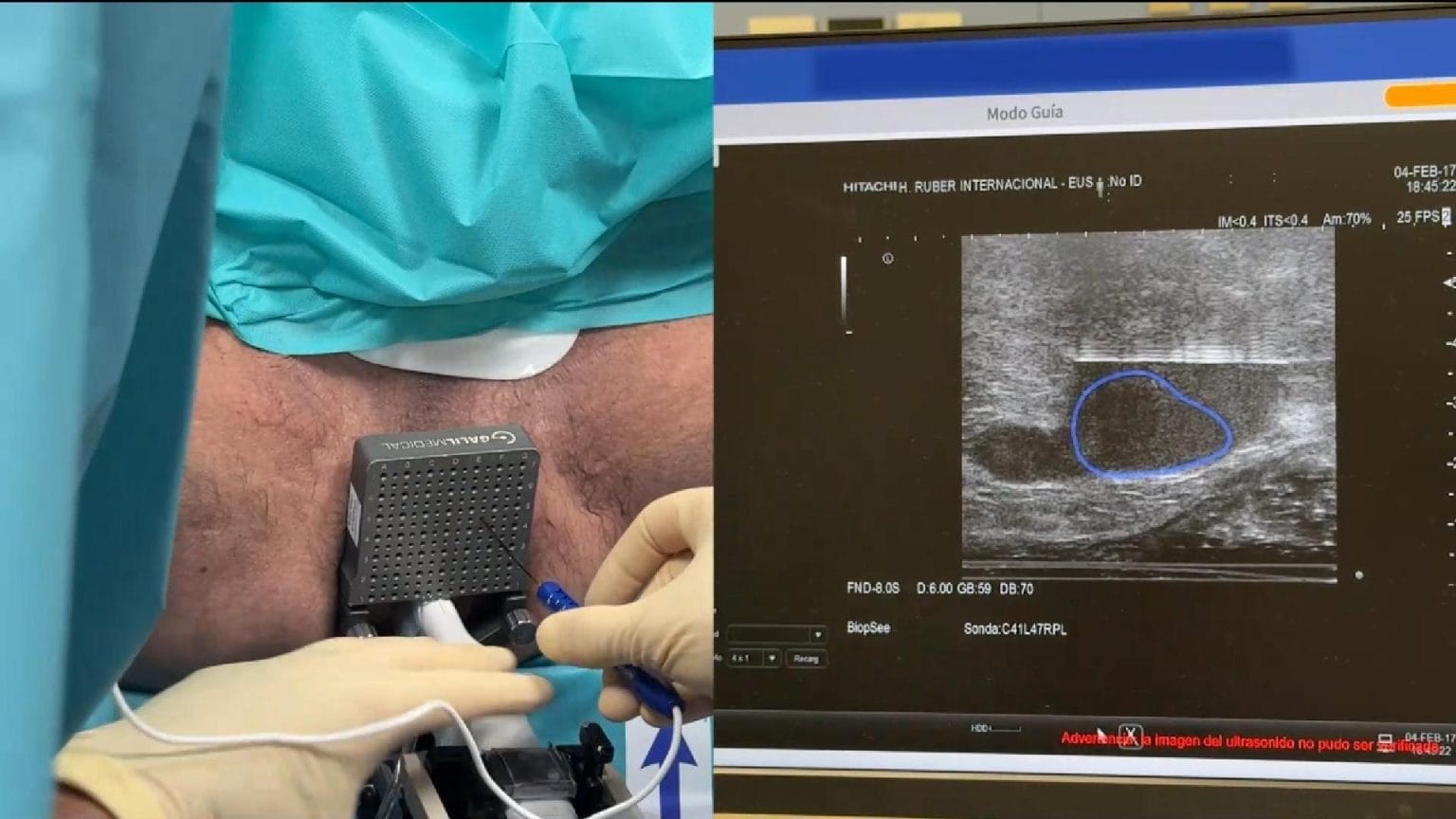 Electroporación irreversible focal del cáncer de próstata con NanoKnife