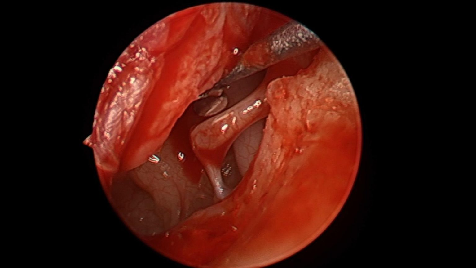 Estapedotomía endoscópica por otosclerosis del Dr. Jimmy Prueter