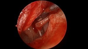 Estapedotomía endoscópica por otosclerosis del Dr. Jimmy Prueter