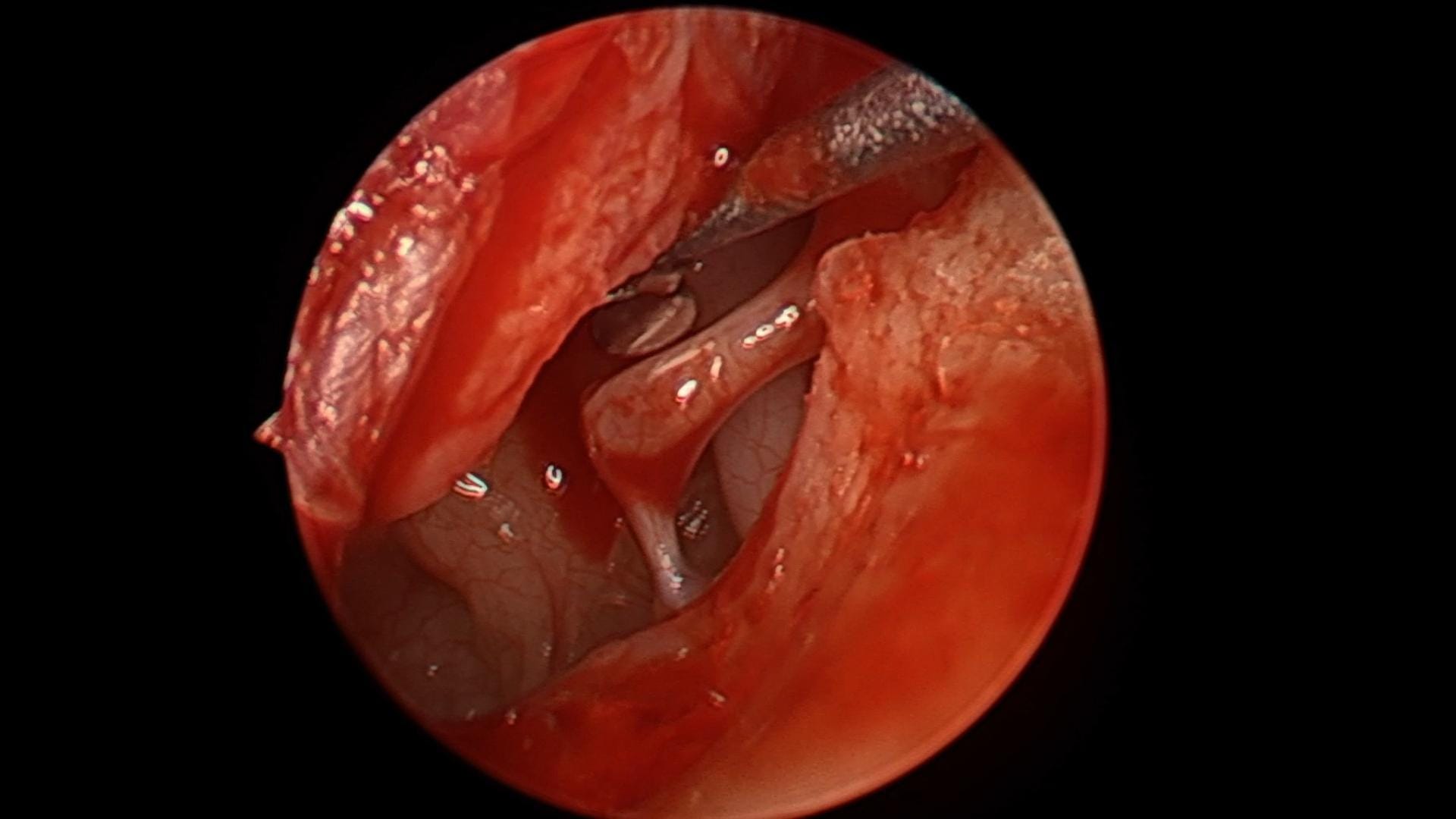 Estapedotomía endoscópica por otosclerosis del Dr. Jimmy Prueter