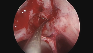 Fístula del canal de Sternberg reparada por vía endoscópica transpterigoidea