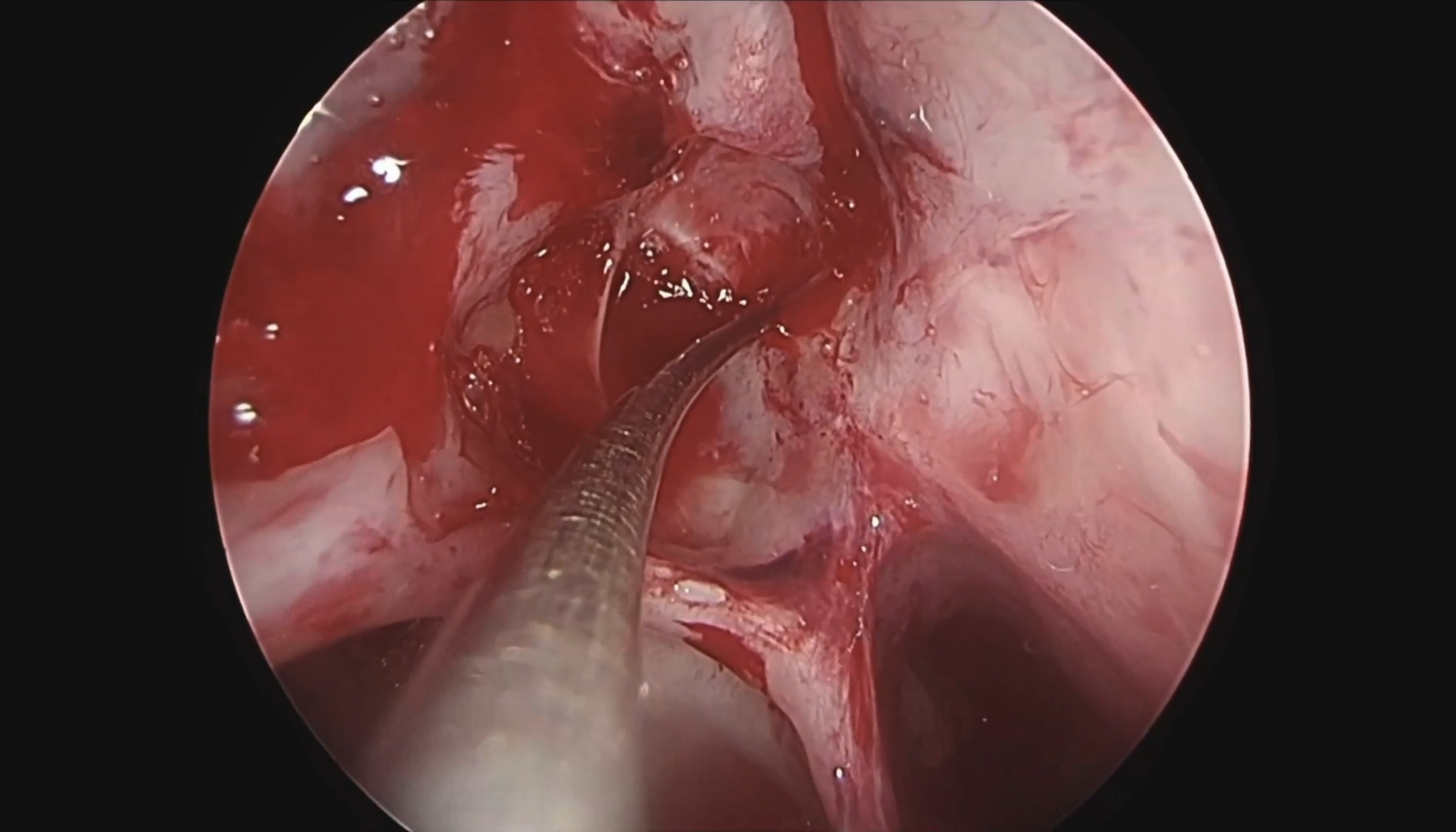 Fístula del canal de Sternberg reparada por vía endoscópica transpterigoidea