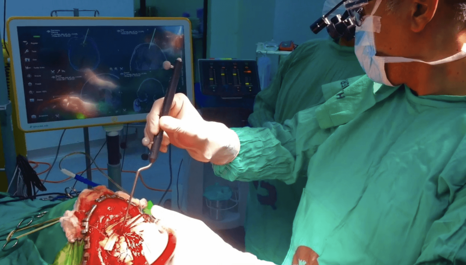 Meningioma del surco olfatorio: abordaje frontobasal extendido con orbitotomía bilateral