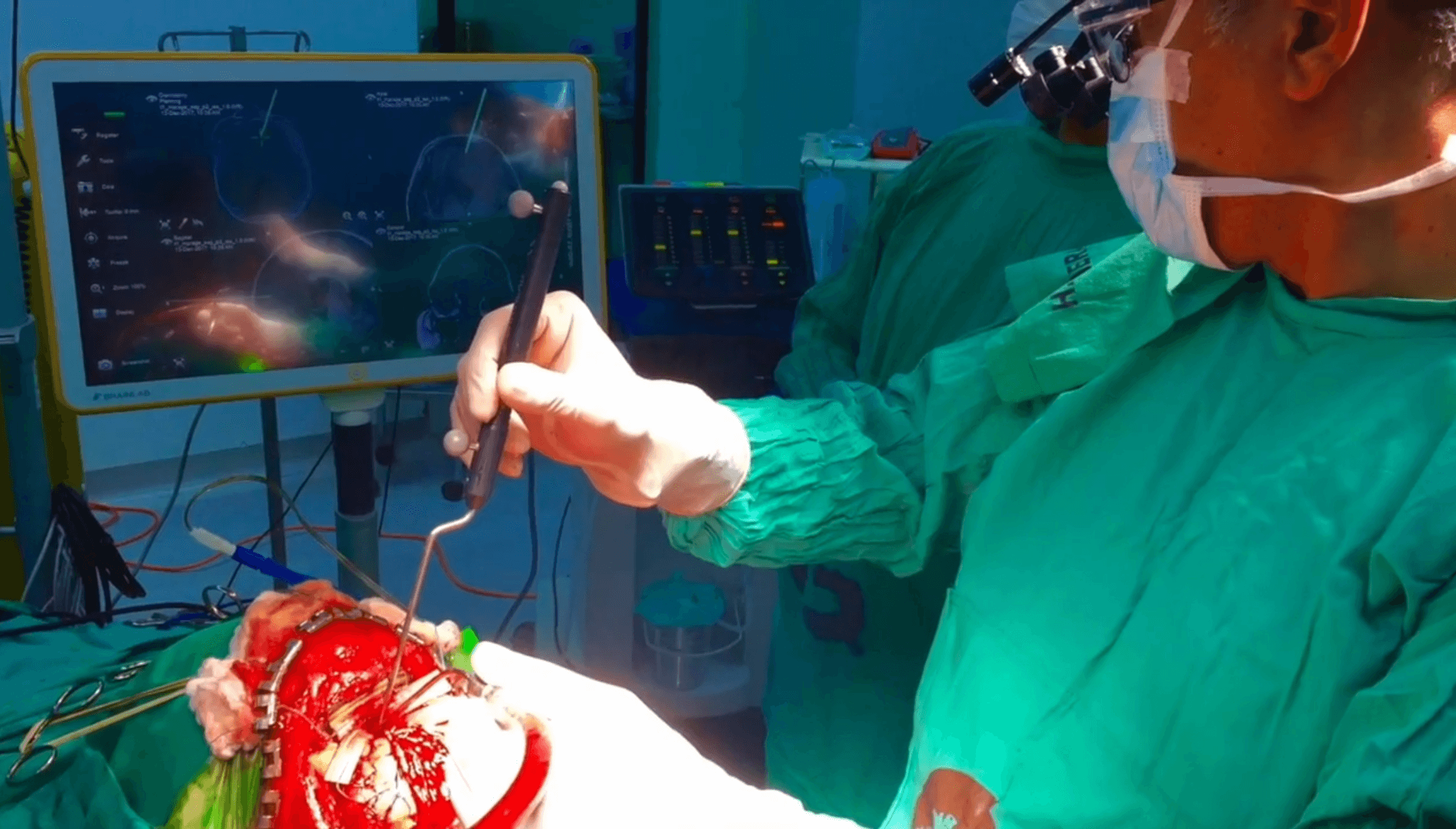 Meningioma del surco olfatorio: abordaje frontobasal extendido con orbitotomía bilateral