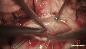 Resección microquirúrgica de tumor intradural extramedular C2-C3
