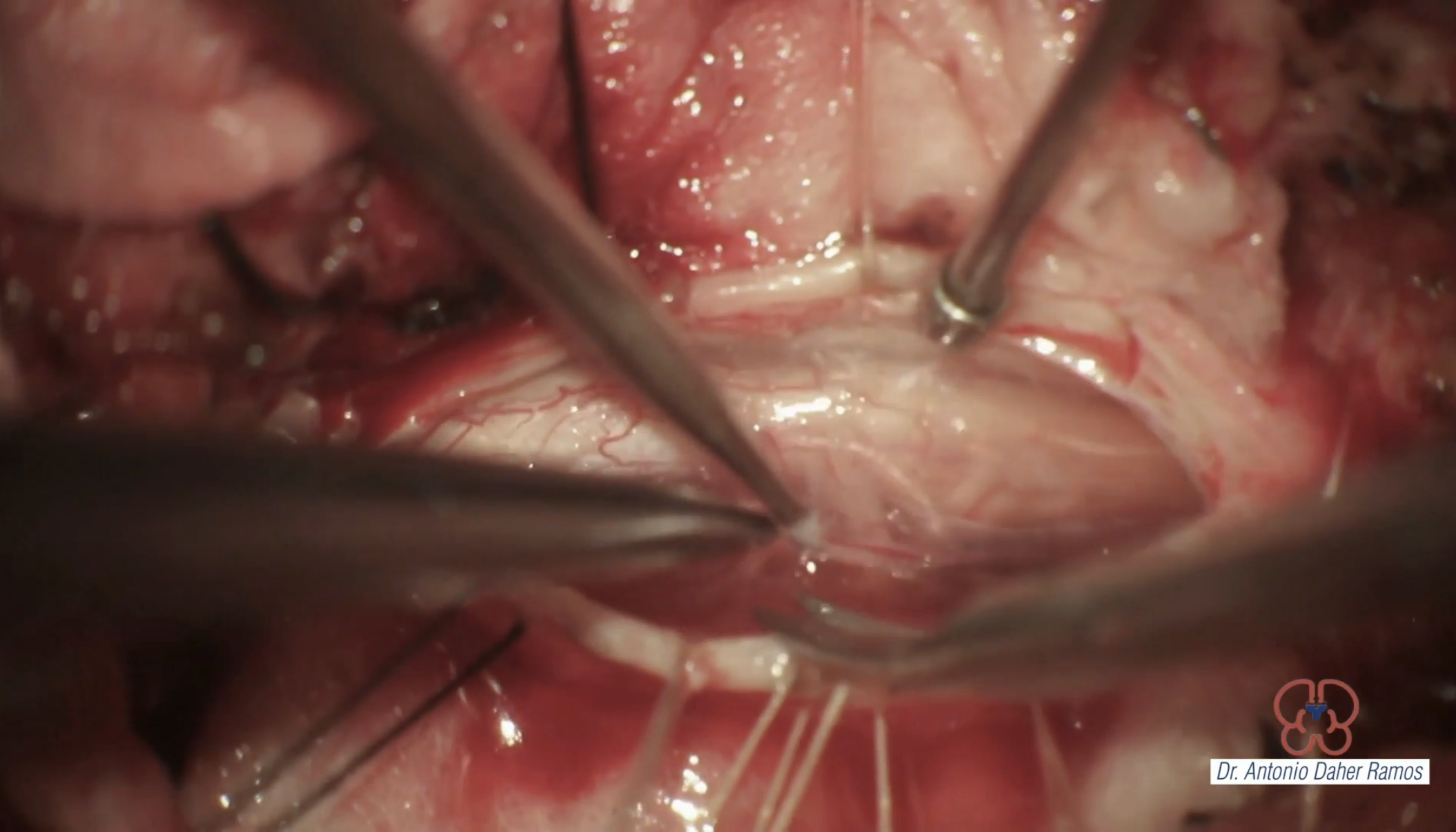 Resección microquirúrgica de tumor intradural extramedular C2-C3